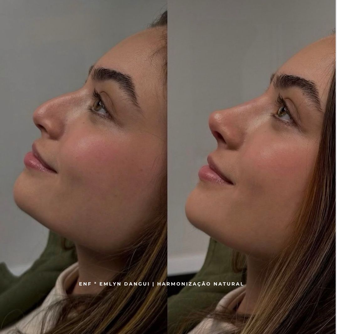 Resultado de tratamento estético facial