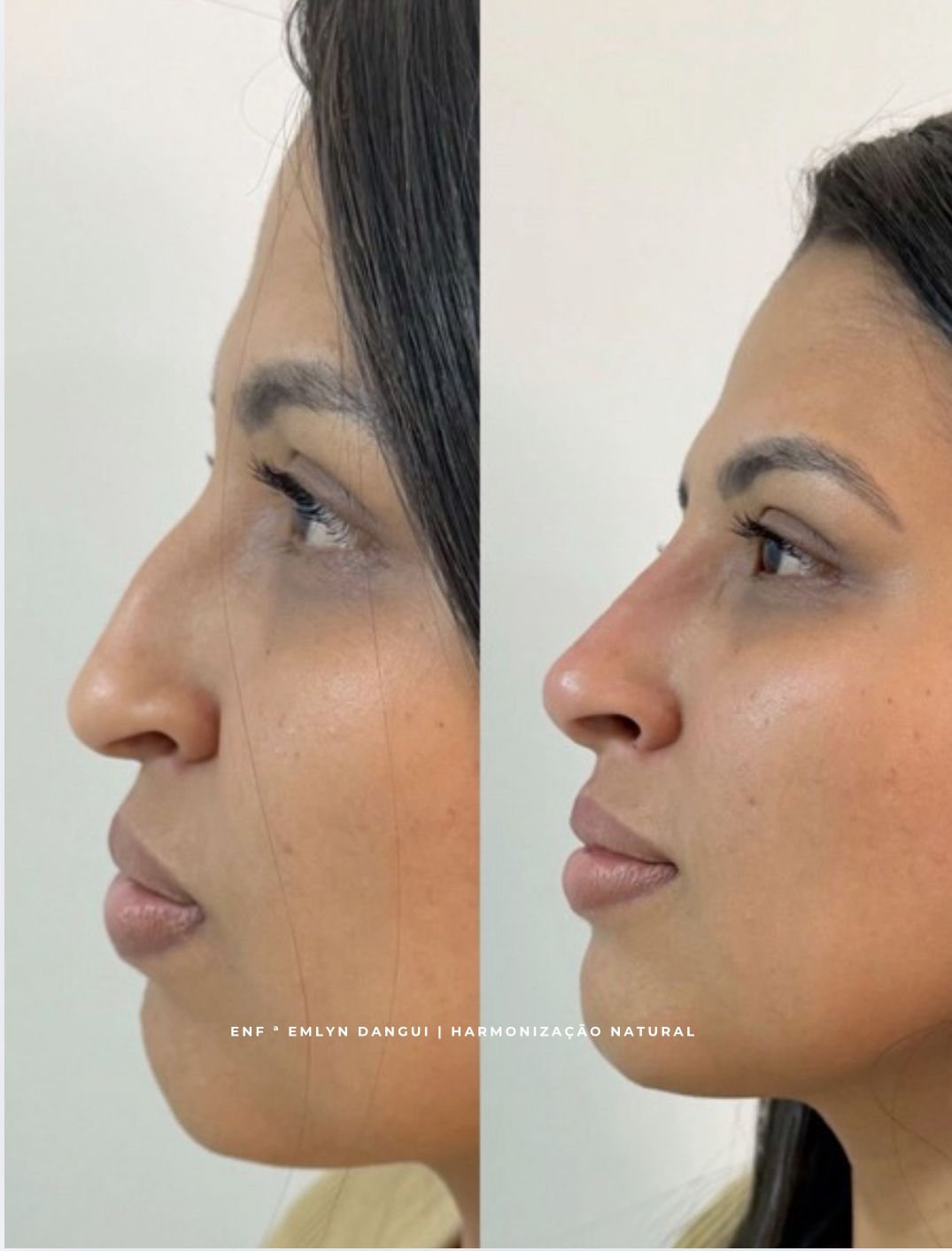 Resultado de tratamento estético facial