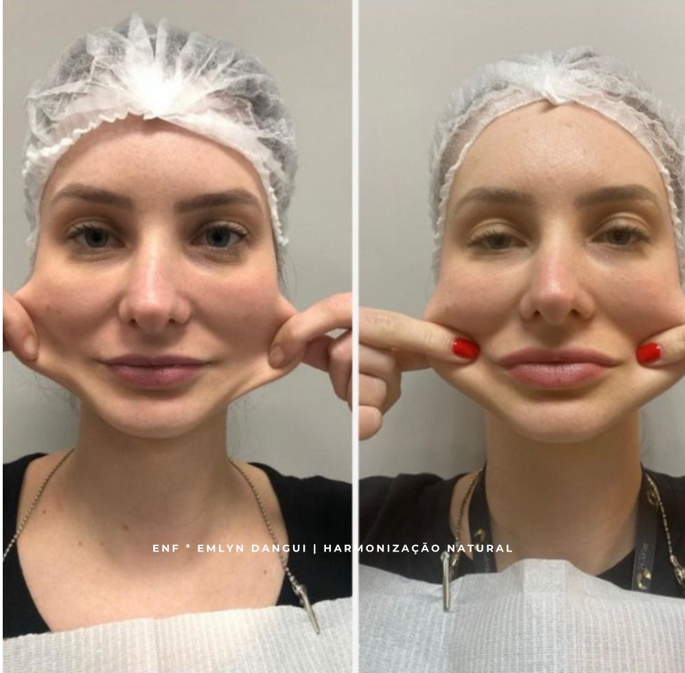 Resultado de tratamento estético facial