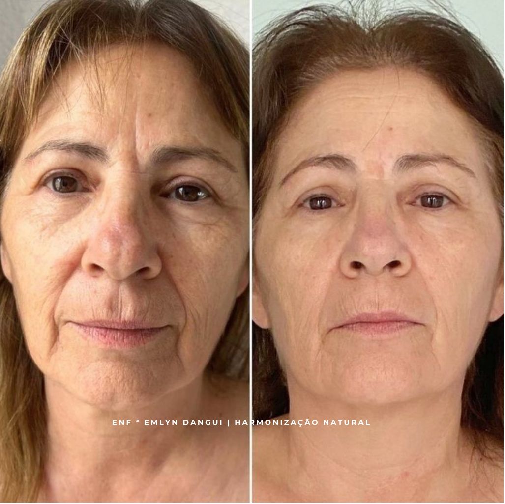 Resultado de tratamento estético facial